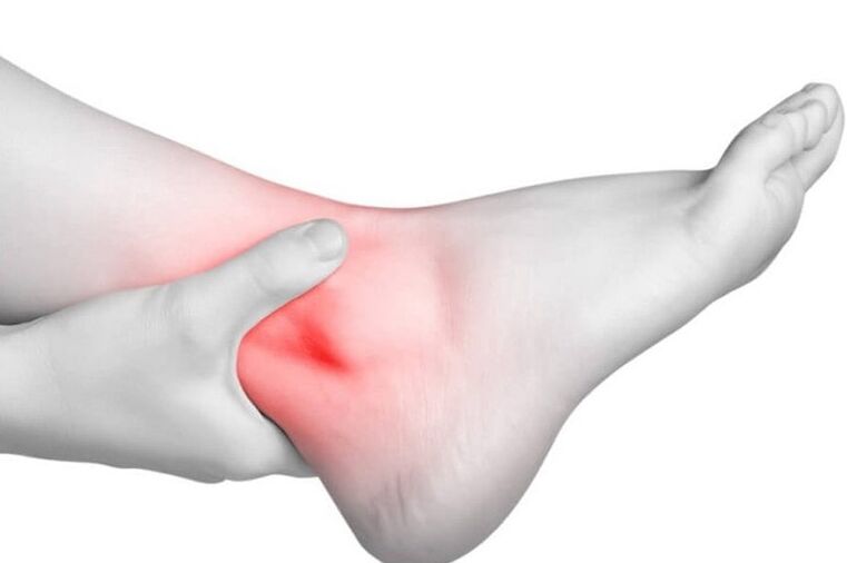Joint inflammation in gout
